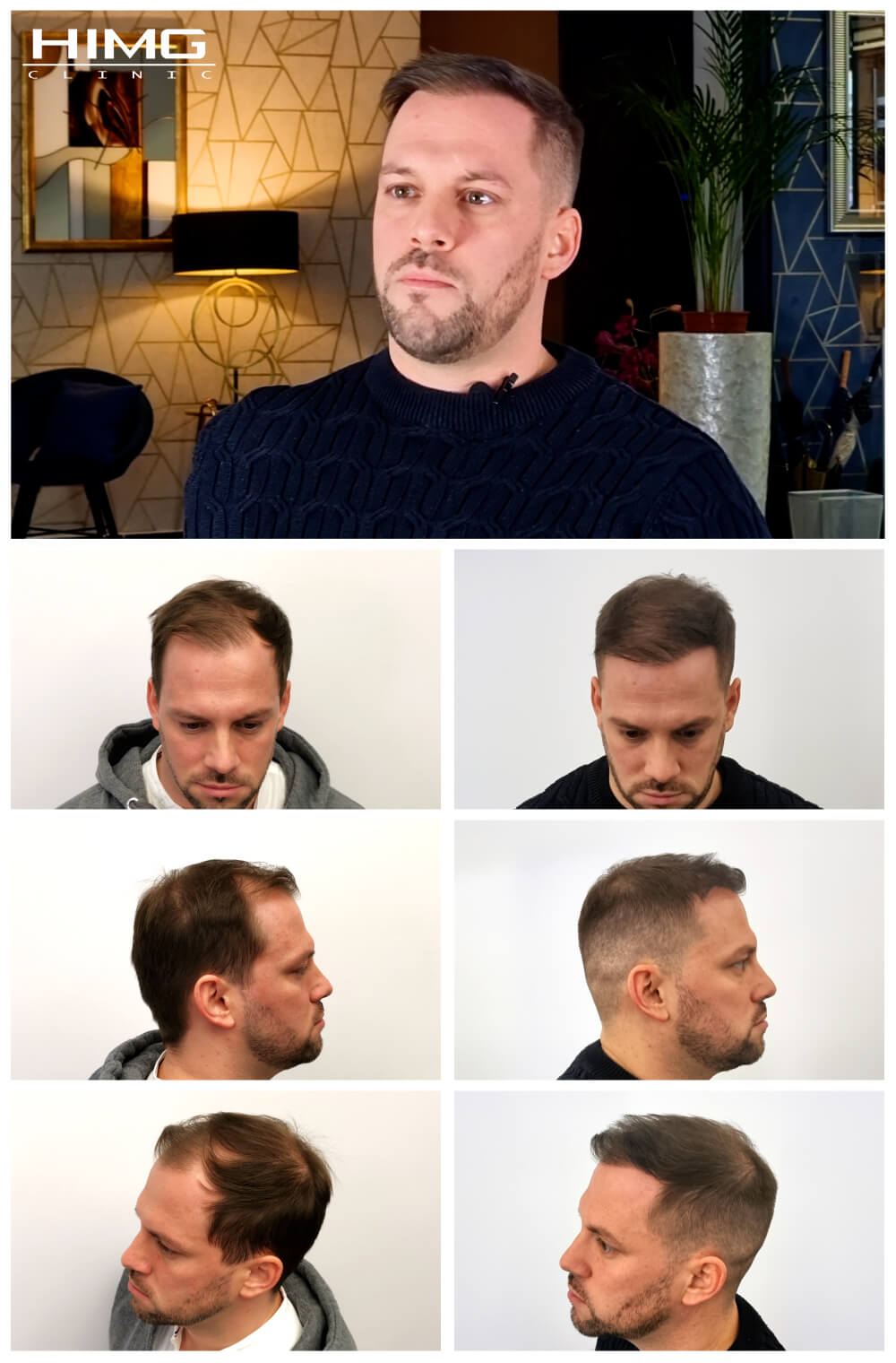 Csuri Ferenc hajbeültetés előtt és után - HIMG Hajbeültetési Klinika