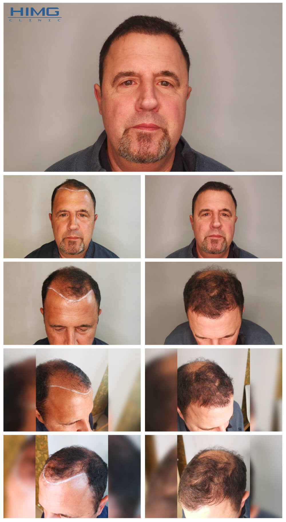 Hajbeültetés előtte-utána: Günther - HIMG hajbeültetési klinika