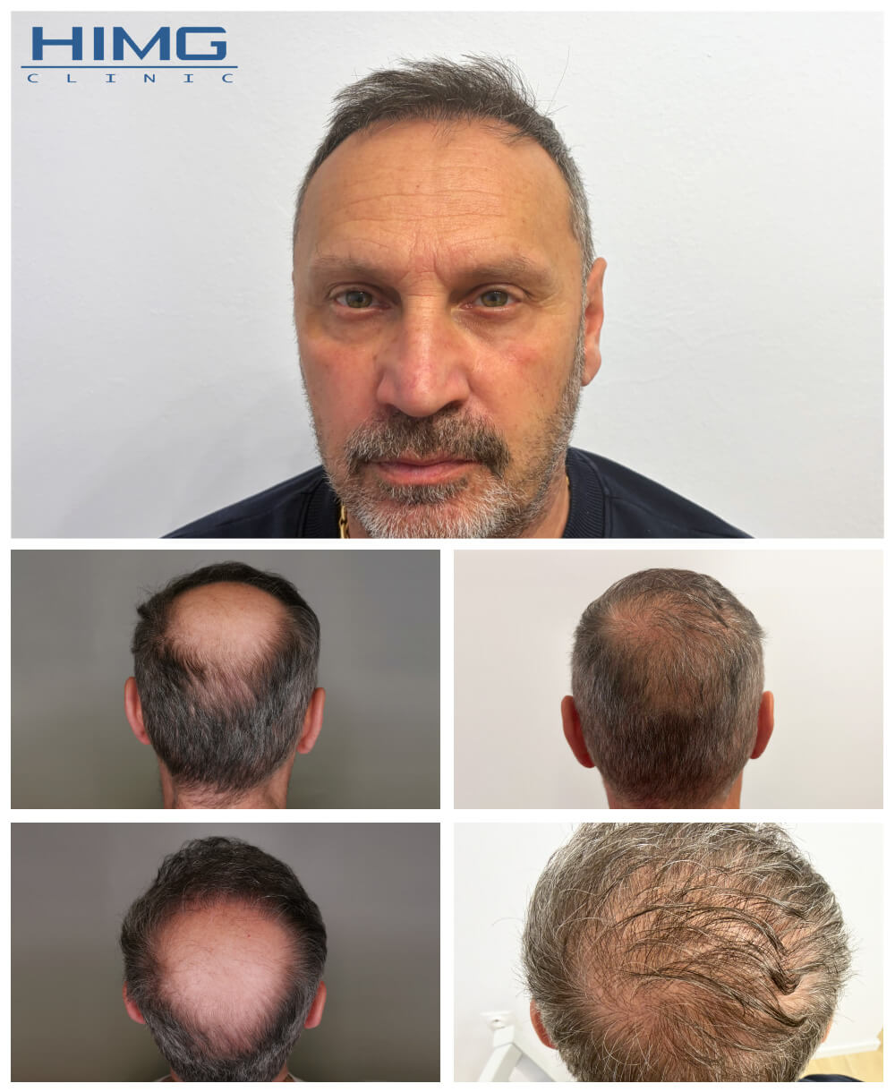 Hajbeültetés előtte-utána: Róbert - HIMG Hajbeültetési Klinika