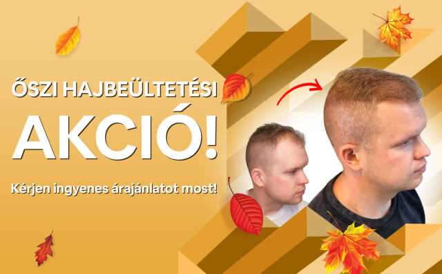 Őszi hajbeültetési akció! - HIMG hajbeültetési klinika