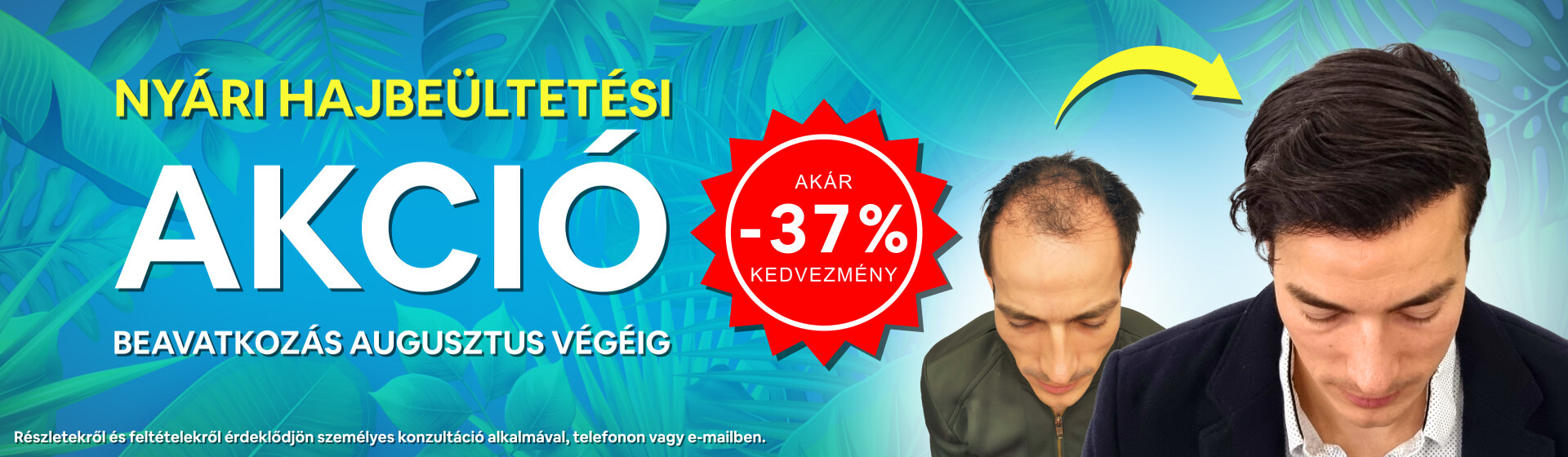 Nyári hajbeültetési akció - HIMG hajbeültetési klinika