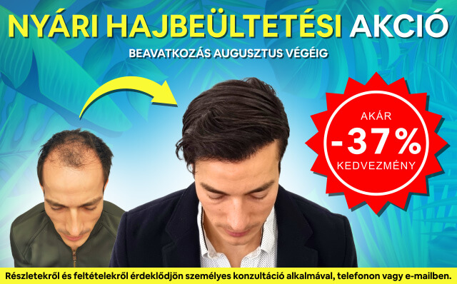 Nyári hajbeültetési akció - HIMG hajbeültetési klinika